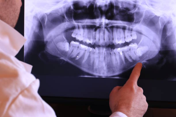 Best Emergency Wisdom Teeth Removal in Cumberland, MD